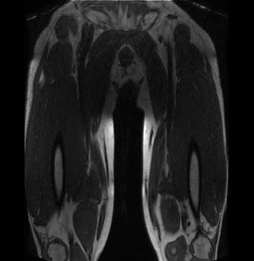 FLASH MRI Thigh image