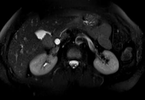 HASTE fat saturated axial sequence used in MRCP imaging