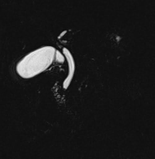 T2 SPACE fat sat coronal sequence used in MRCP imaging