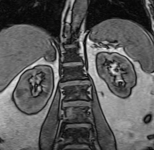 VIBE coronal sequence used in adrenal gland imaging