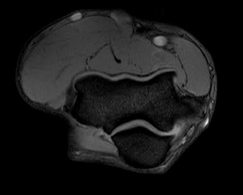 Axial MEDIC sequence used in elbow imaging