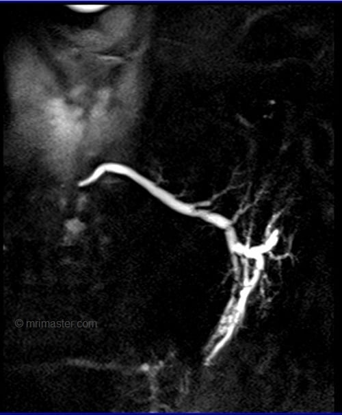 HASTE coronal 30 mm sequence used in sialography imaging imaging