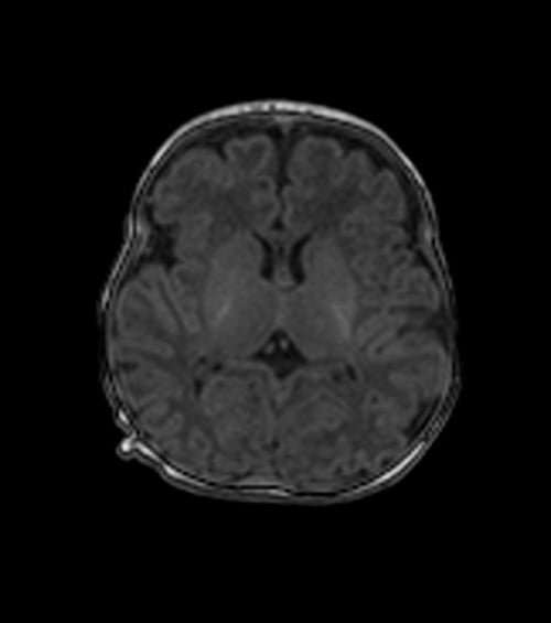 MPRANGE axial sequence used in Pediatric brain imaging