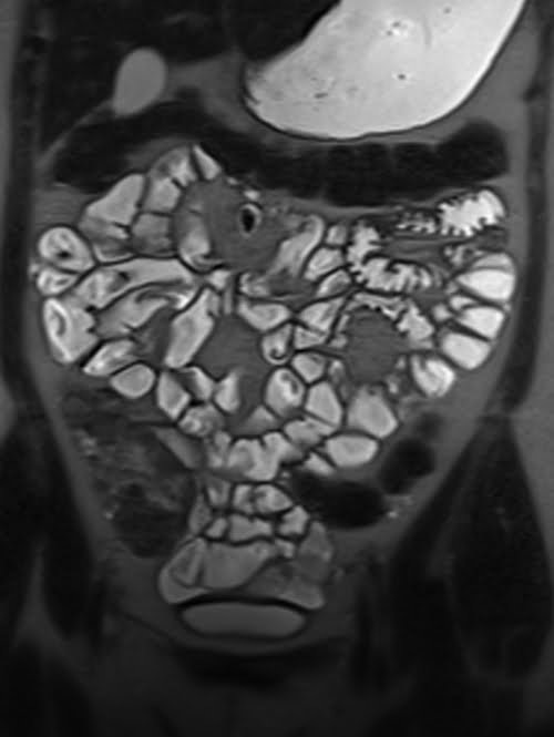 HASTE coronal sequence used in enterography imaging
