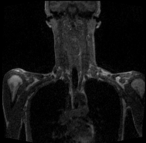 FLASH MRI neck image