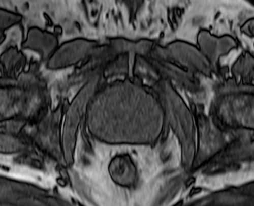 VIBE axial sequence used in prostate imaging