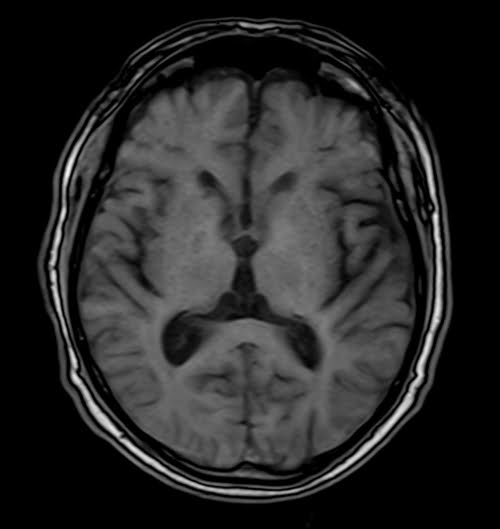 VIBE axial sequence used in uncooperative patients brain imaging