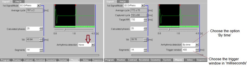 Arrhythmia correction cardiac MRI