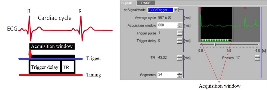 Prospective Triggering mri cardiac