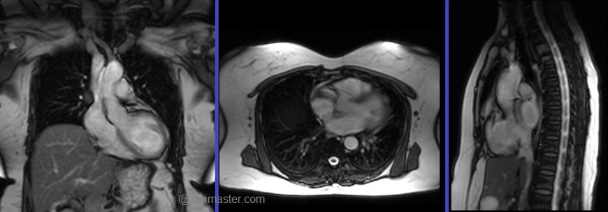 cardiac mri localiser