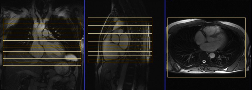 cardiac mri protocols and planning of axial dark blood