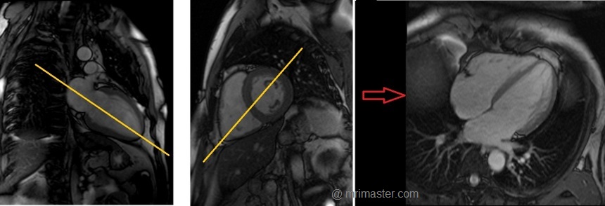 cardiac mri protocols and planning of four chamber localizer