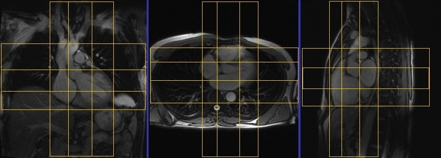cardiac mri protocols and planning of localizer