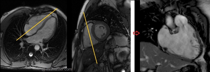 cardiac mri protocols and planning of right two chamber cine