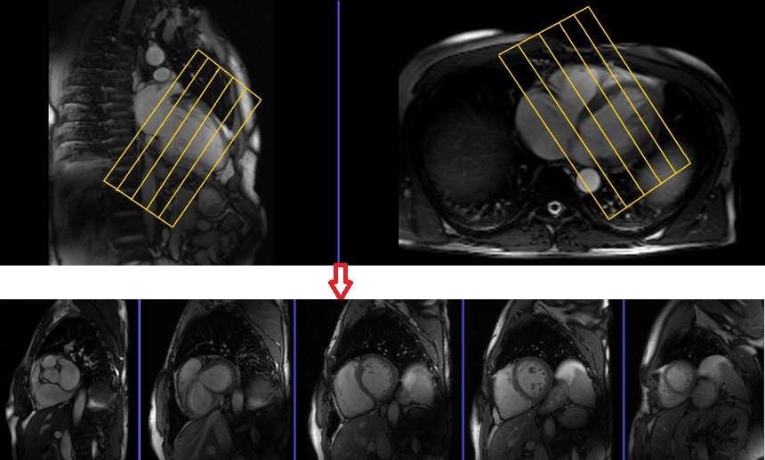 cardiac mri protocols and planning of short axis localizer