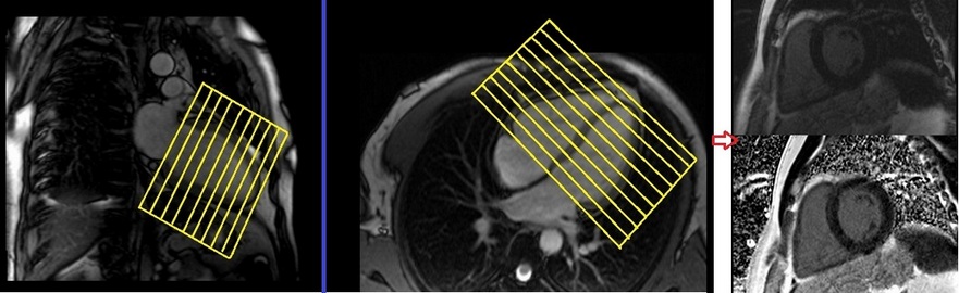 cardiac mri protocols and planning of short axis psir