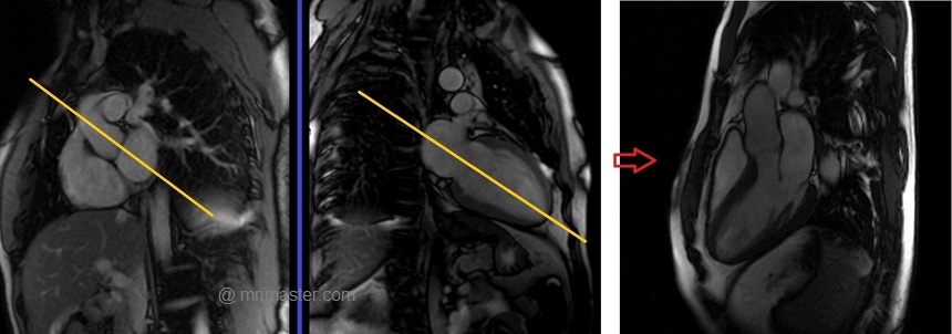 cardiac mri protocols and planning of three chamber cine