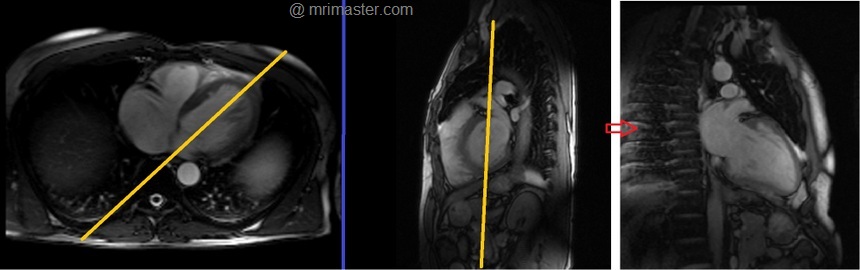 cardiac mri protocols and planning of two chamber localizer