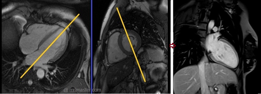 cardiac mri protocols and planning of two chamber post gd