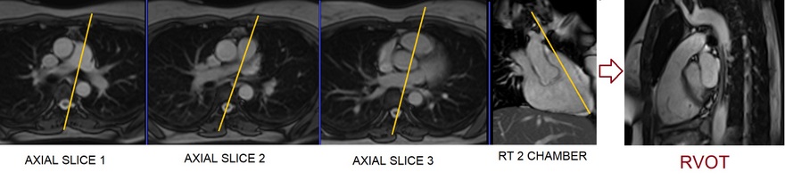 right ventricular outflow tract (RVOT) cardiac MRI planning image