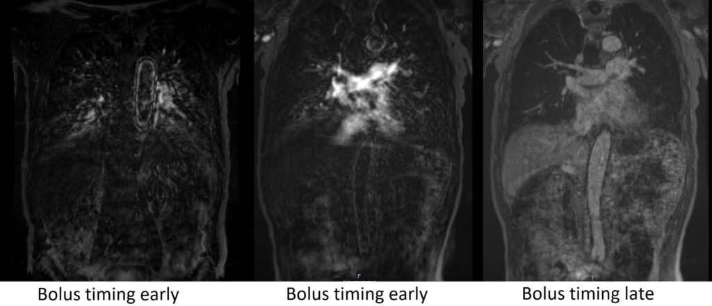 Bolus timing artifact mri