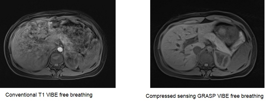Compressed sensing GRASP VIBE MRI