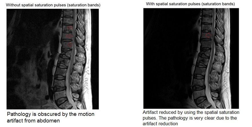MRI Artifacts reduced by using the Spatial saturation pulses (saturation bands)