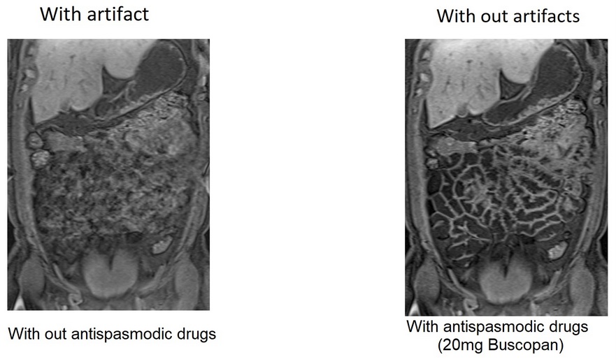 MRI Motion artifact reduction using antispasmodic drugs(buscopan 20mg)
