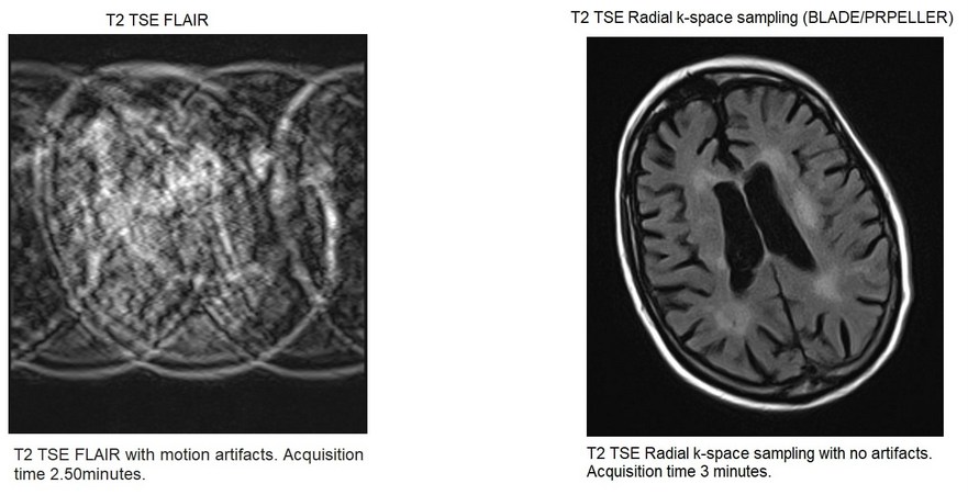 MRI Radial k-space sampling (BLADE or PRPELLER) with no motion artifacts