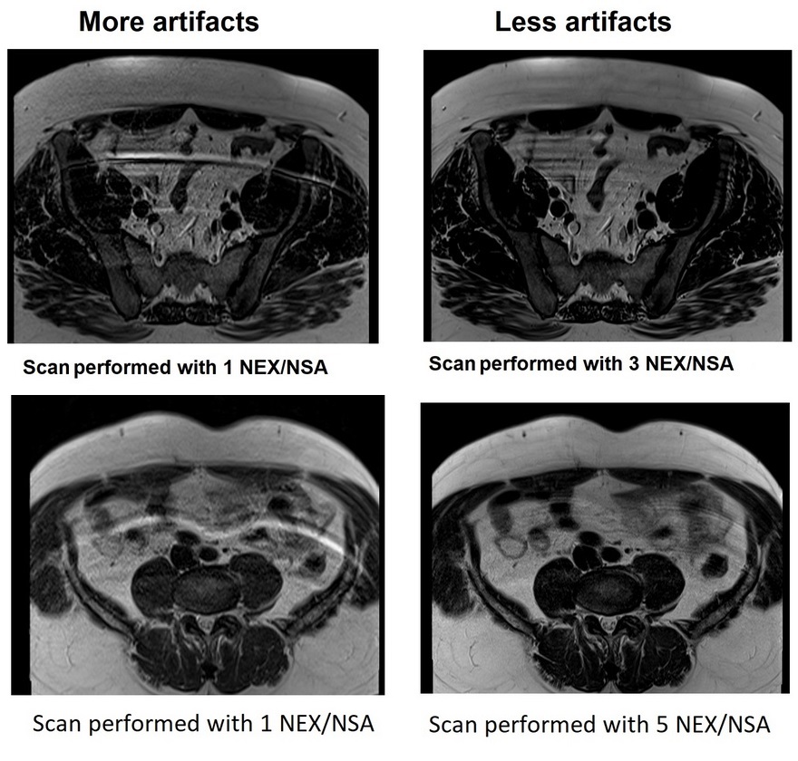 MRI artifacts and Number of signal averaging NEX