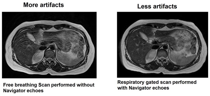 MRI artifacts reduced by using Navigator echoes