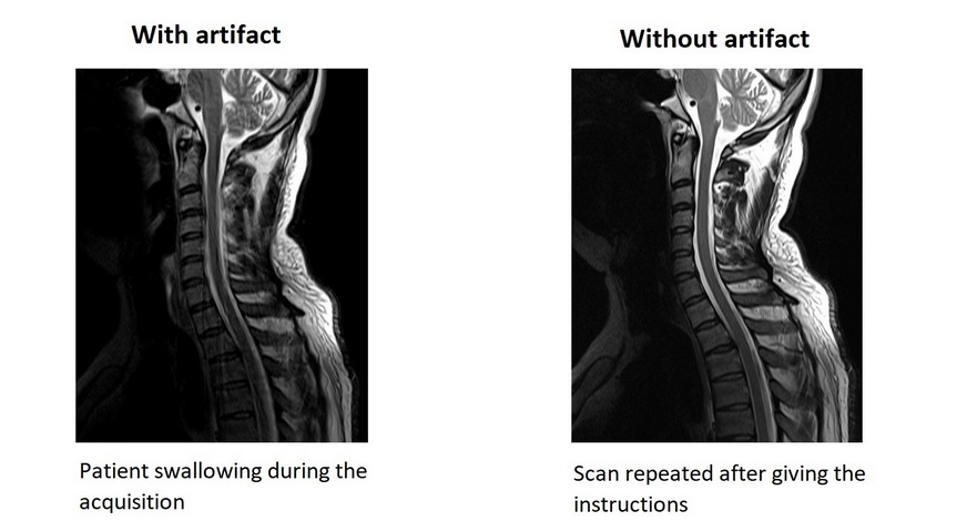 MRI motion artifact due to patient swallowing