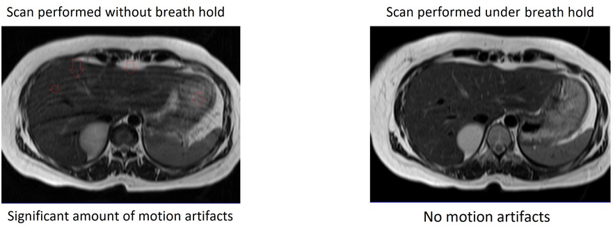 Respiratory Motion artifacts MRI