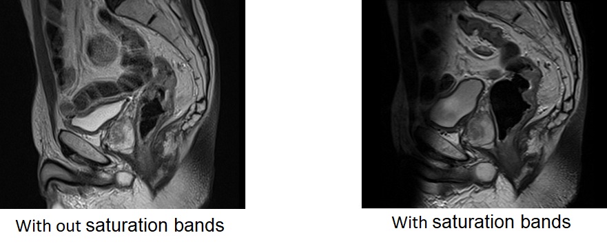Spatial saturation pulses (saturation bands) over the moving anatomy