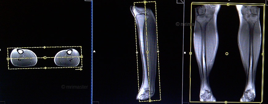 magnetic resonance angiography(MRA) whole body protocols and planning of lower legs post contrast scans