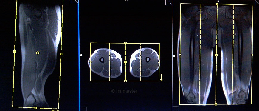 magnetic resonance angiography(MRA) whole body vessel localizer upper leg