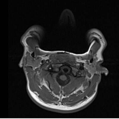magnetic susceptibility artifact brain magnetic susceptibility artifact brain