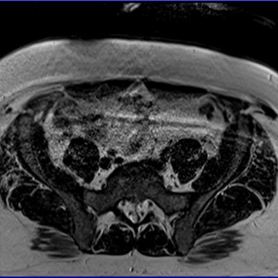 Motion artifact MRI pelvis axial Motion artifact MRI pelvis axial