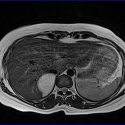 Motion artifact MRI abdomen axial Motion artifact MRI abdomen axial