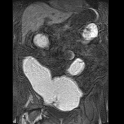 Motion artifact MRI abdomen Motion artifact MRI abdomen