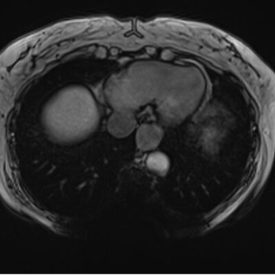 05F2E96A magnetic susceptibility artifact brain