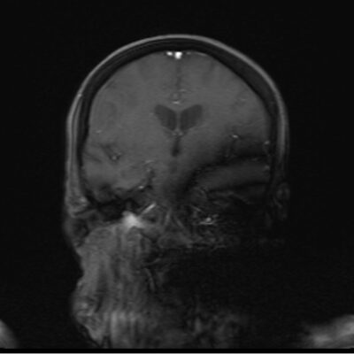 magnetic susceptibility artifact neck magnetic susceptibility artifact neck