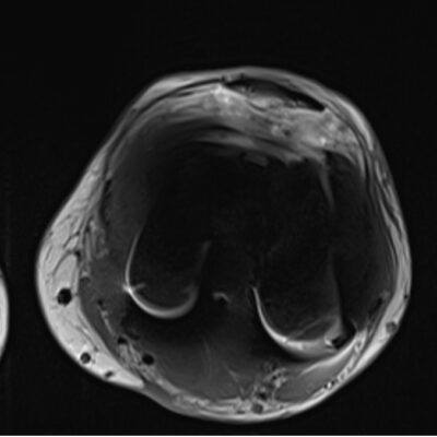 magnetic susceptibility artifact knee magnetic susceptibility artifact knee