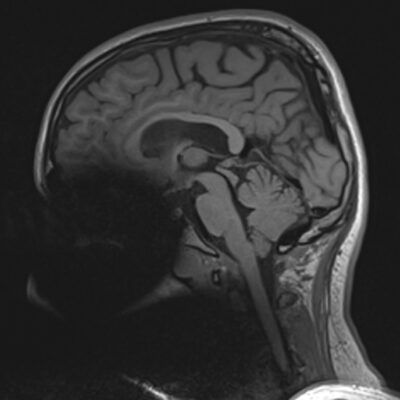 magnetic susceptibility artifact FACE magnetic susceptibility artifact FACE