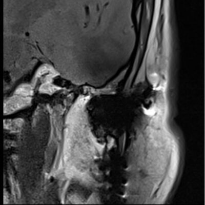 magnetic susceptibility artifact TMJ’S magnetic susceptibility artifact TMJ'S