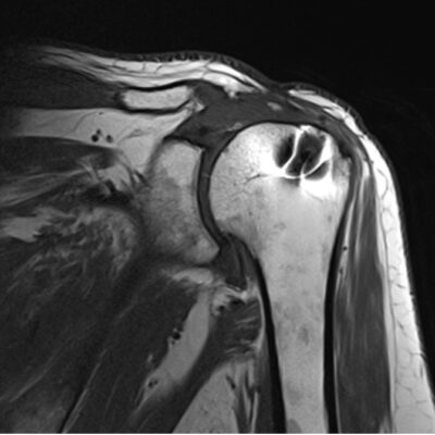 magnetic susceptibility artifact shoulder magnetic susceptibility artifact shoulder