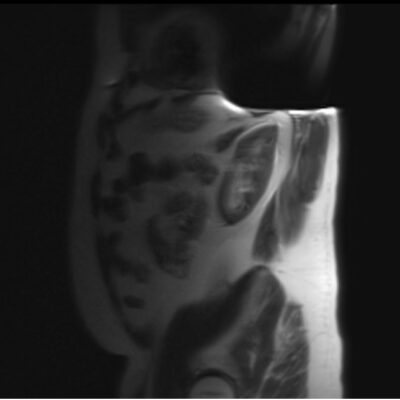 magnetic susceptibility artifact abdomen magnetic susceptibility artifact abdomen