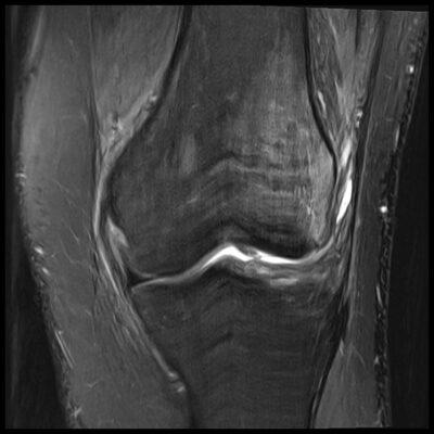 MRI motion artifact knee MRI motion artifact knee