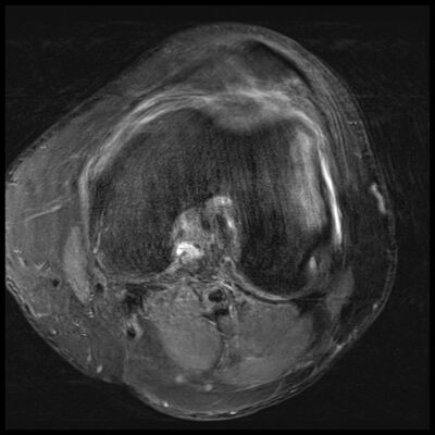 MRI motion artifact knee MRI motion artifact knee