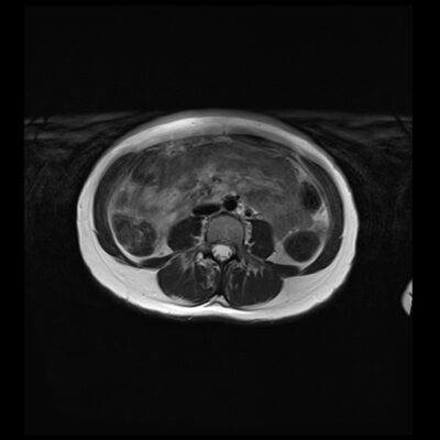 MRI motion artifact abdomen t2 MRI motion artifact abdomen t2